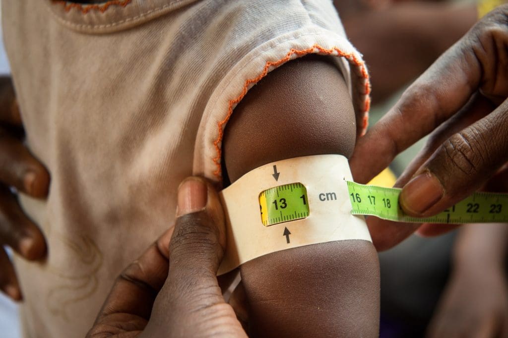 A nurse measures a child's arm with a colored band, this child's band points to the green or healthy area
